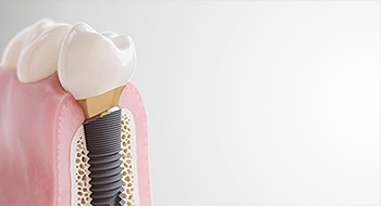 Dentsply